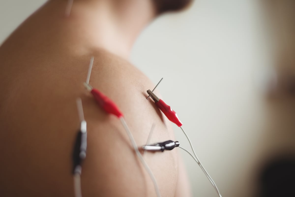 Tratamiento de punción seca con electroestimulación
